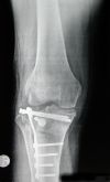 Μετατραυματική αρθρίτιδα δεξιού γόνατος σε άνδρα 42 ετών