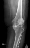 Ασθενής 77 ετών με προχωρημένη οστεοαρθρίτιδα του αριστερού γόνατος